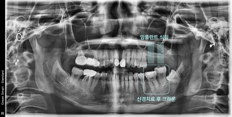 턱 아파서 입이 안 벌어진다고요? 임플란트, 포기하지 마세요.