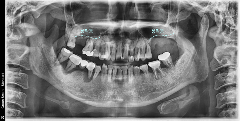 상악동 위치를 표시한 엑스레이