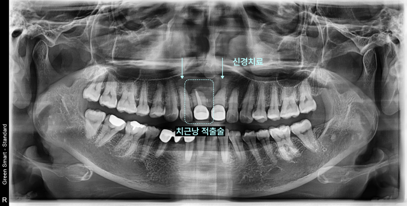 치아 엑스레이 사진에 신경치료와 치근낭 적출술 표시