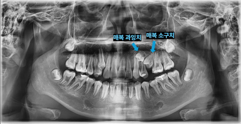 태전동치과 “아프지도 않은데 꼭 빼야 하나요?” 성장기 매복 과잉치, 구강외과 전문의에게 발치해야 하는 이유 3 매복 과잉치와 매복 소구치를 보여주는 엑스레이 사진