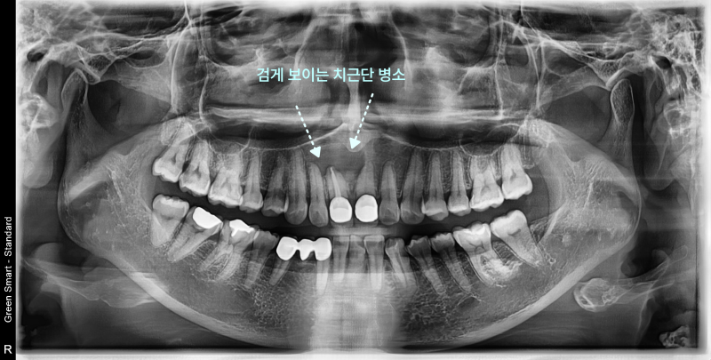 치아 엑스레이 사진에 검게 보이는 치근단 병소 표시