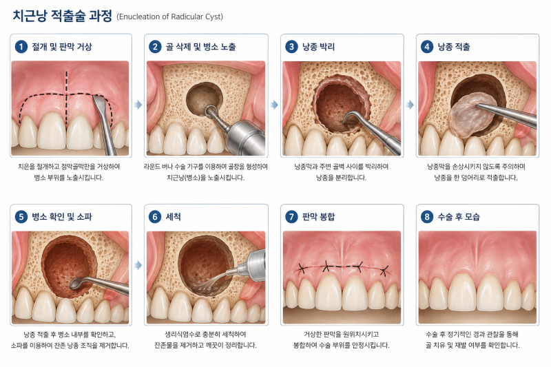 치근낭 적출술 8단계 과정 설명 그림