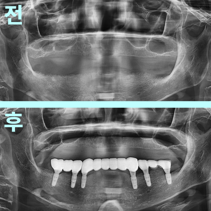 태전동치과 임플란트 비용, 무조건 비쌀까요? 현명하게 줄이는 법