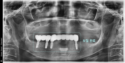 태전동치과 임플란트 비용, 무조건 비쌀까요? 현명하게 줄이는 법