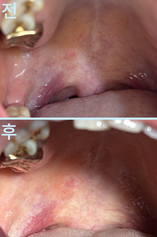 초월역치과 아프지 않은 입천장 혹, 작다고 그냥 두면 안 되는 이유