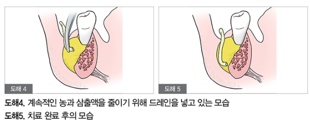 “신경치료까지 했는데 왜 또 붓죠?” 앞니 잇몸 염증, 원인부터 잡아야 합니다. 6 농과 삼출액을 줄이기 위해 드레인을 넣는 모습과 치료 완료 후 모습