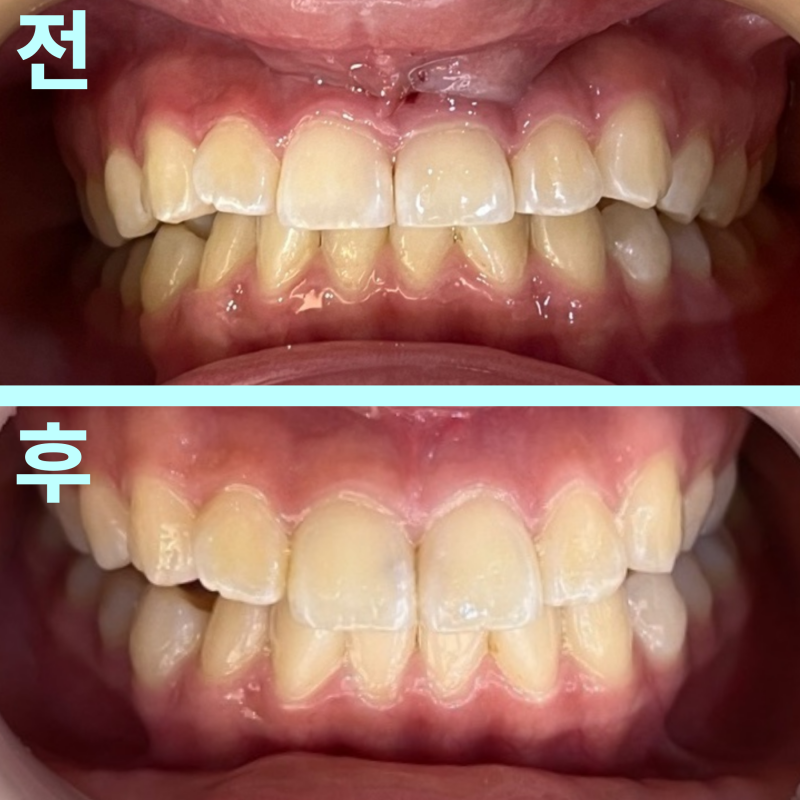 “신경치료까지 했는데 왜 또 붓죠?” 앞니 잇몸 염증, 원인부터 잡아야 합니다. 18 “신경치료까지 했는데 왜 또 붓죠?” 앞니 잇몸 염증, 원인부터 잡아야 합니다.