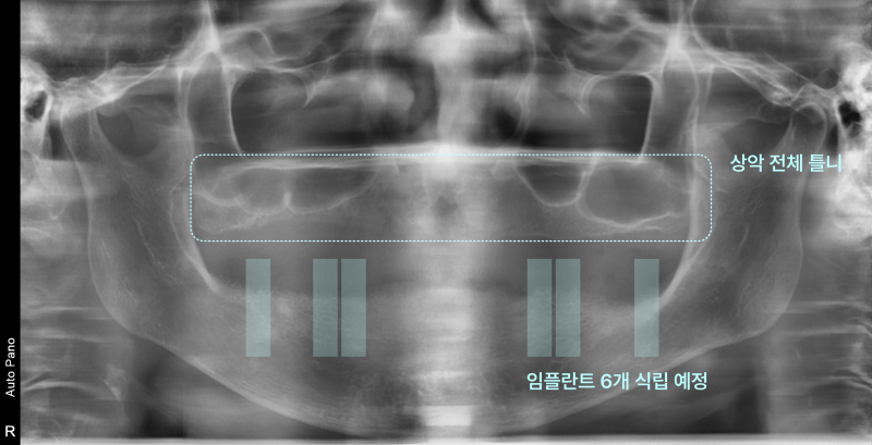 상악 전체 틀니와 임플란트 6개 식립 예정 표시가 있는 엑스레이