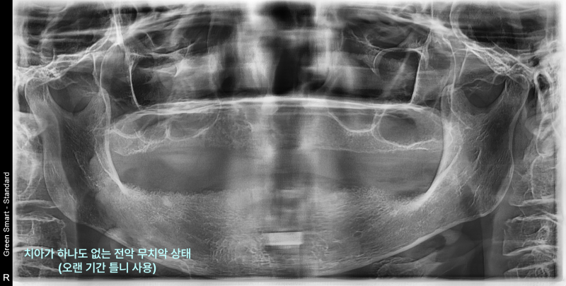 치아가 하나도 없는 전악 무치악 상태의 엑스레이