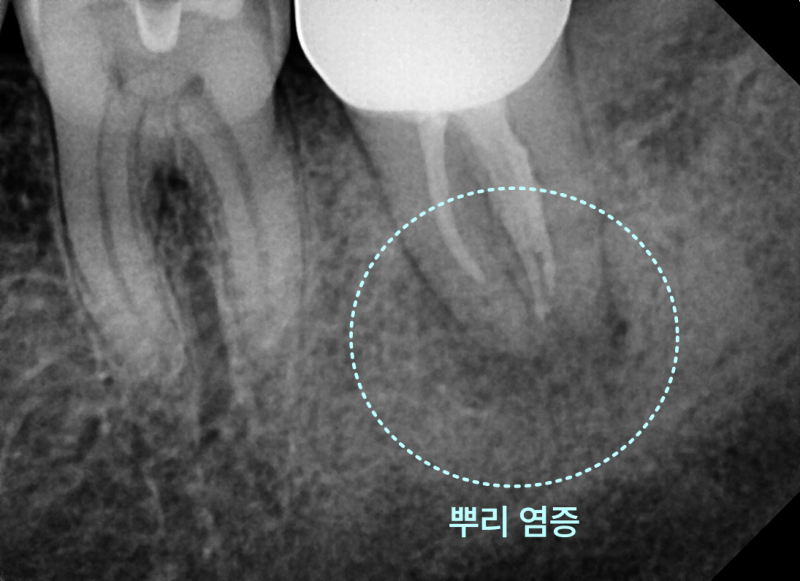 경기광주치과 “빼야 할 것 같아요” 진단받은 어금니, 의도적 재식술로 살린 이야기 3 어금니 뿌리 염증을 확대한 엑스레이 사진