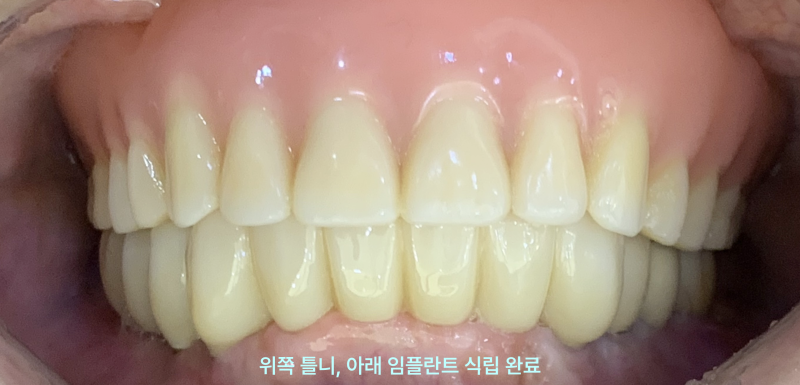 태전동치과 임플란트 비용, 무조건 비쌀까요? 현명하게 줄이는 법